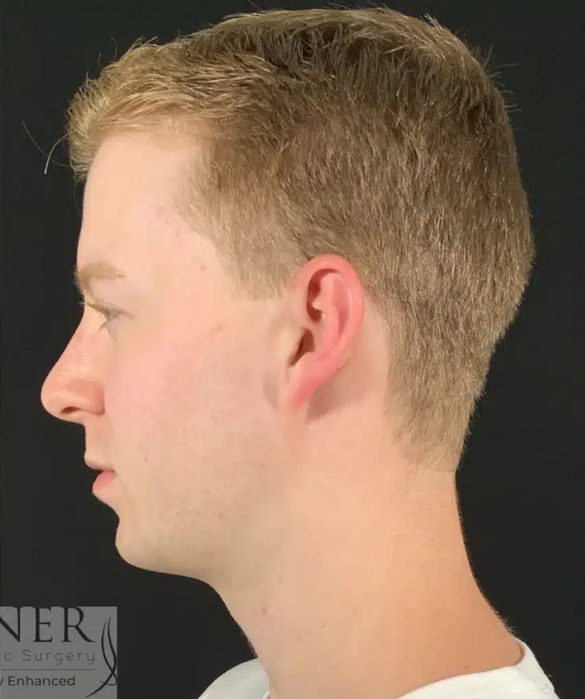 Chin Augmentation before and after - after