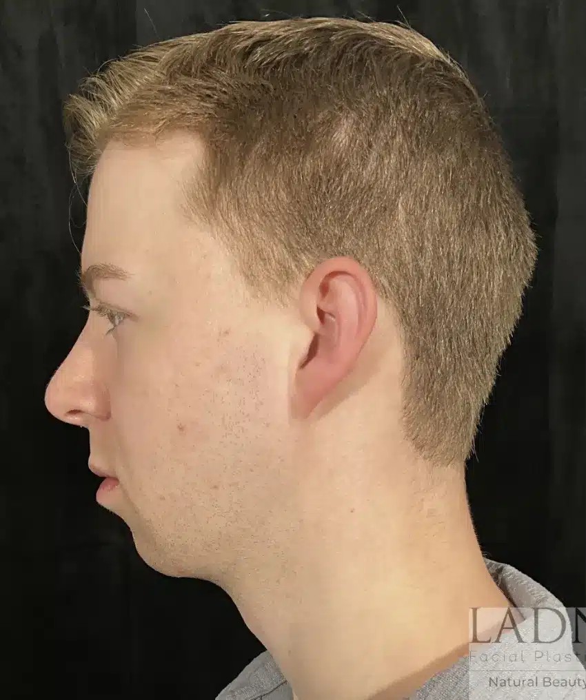 Chin Augmentation before and after - before