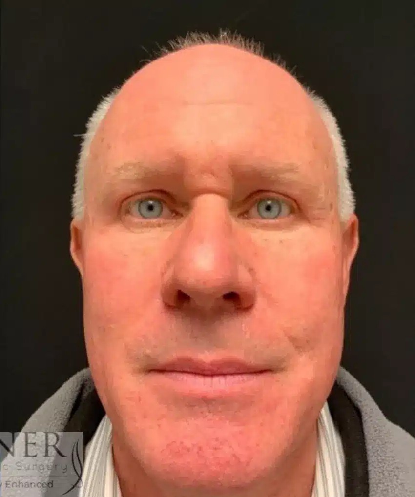 Upper Blepharoplasty & Facial Plastic Surgery before and after - after
