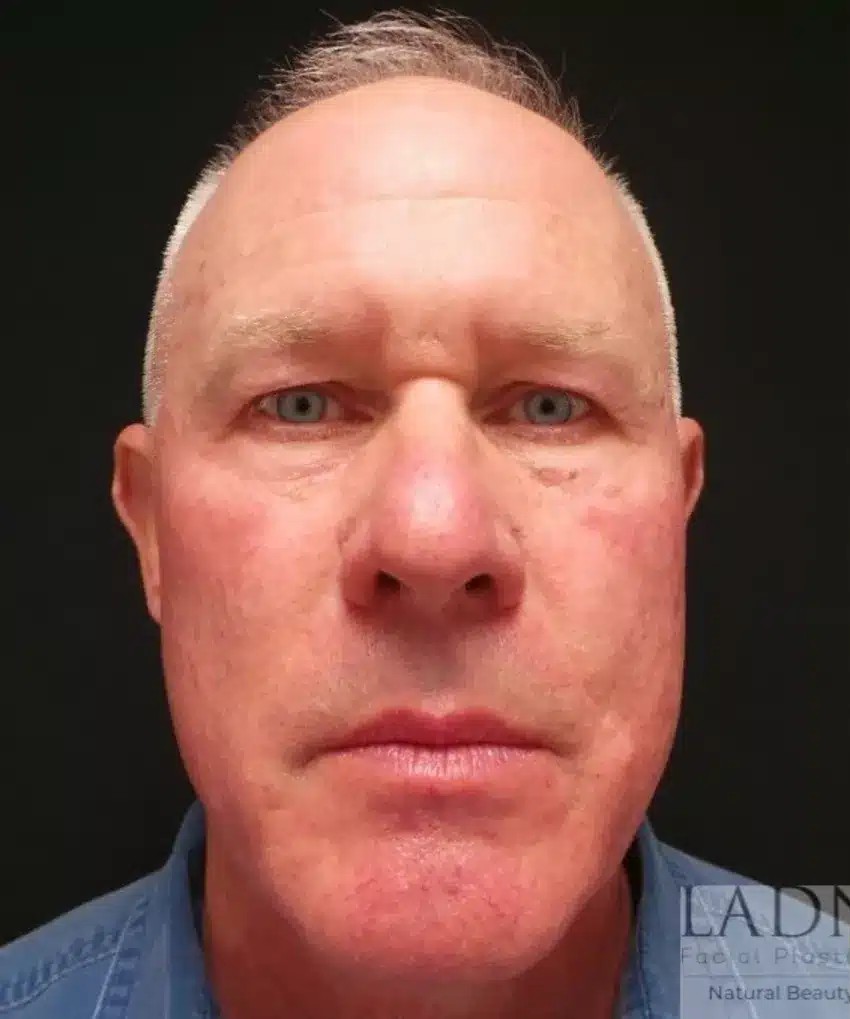 Upper Blepharoplasty & Facial Plastic Surgery before and after - before