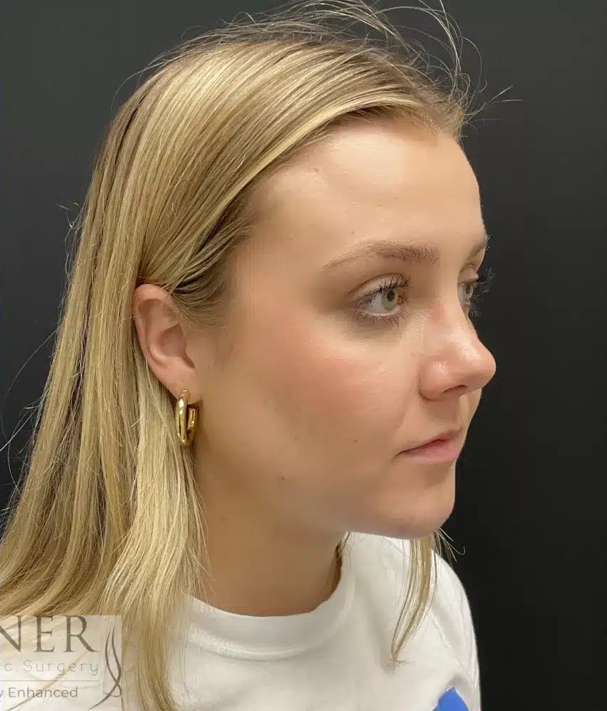 Submental Liposuction before and after - after