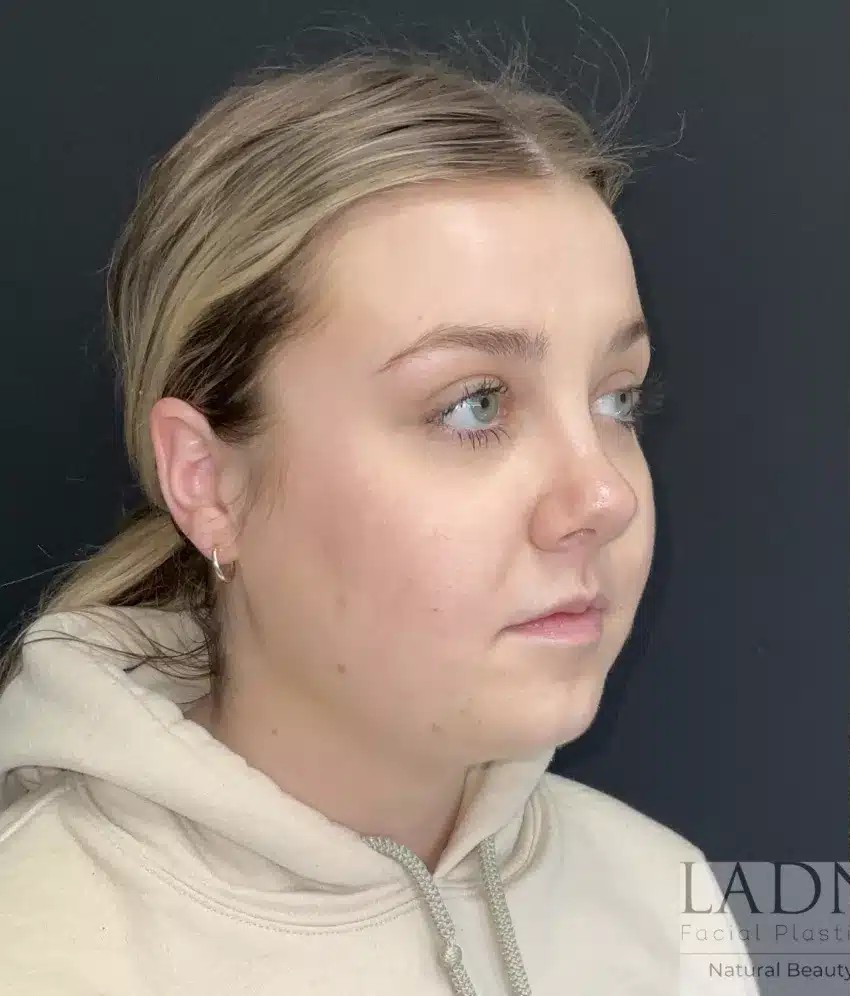 Submental Liposuction before and after - before
