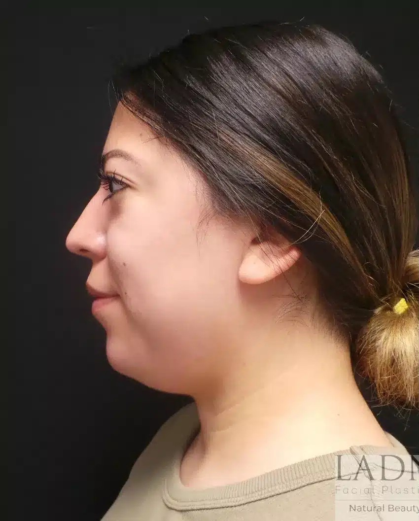 Submental Liposuction before and after - before