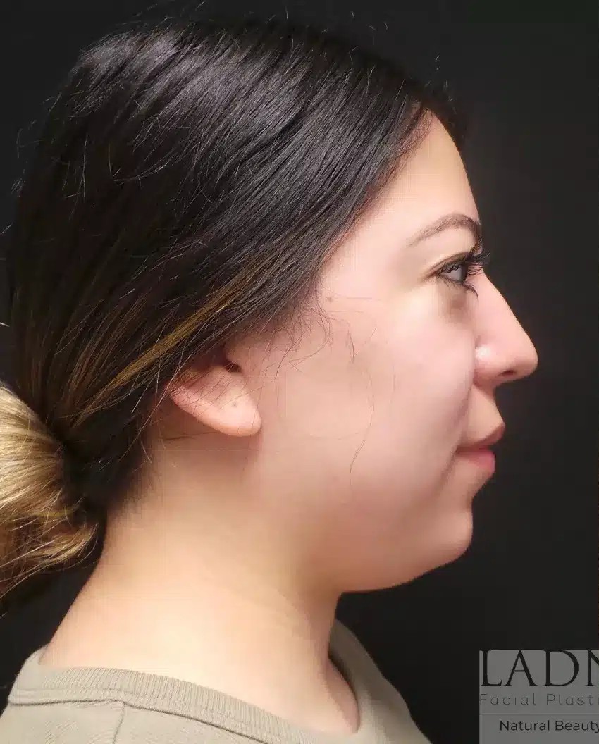 Submental Liposuction before and after - before