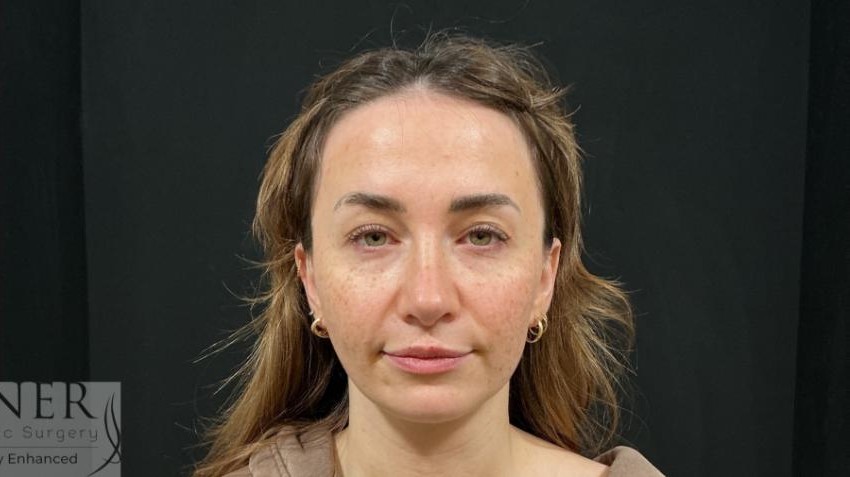 Open Rhinoplasty before and after - after