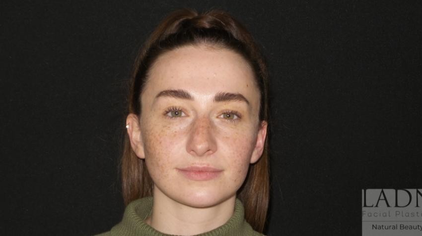 Open Rhinoplasty before and after - before