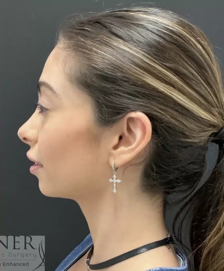 Rhinoplasty before and after - after