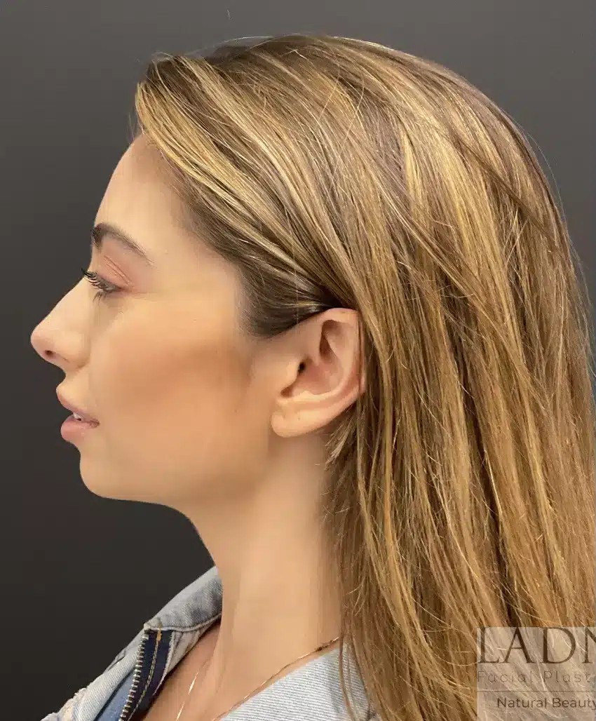 Rhinoplasty before and after - before