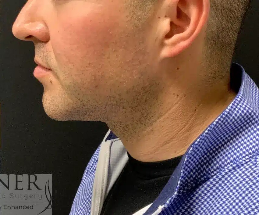 Chin Augmentation before and after - after