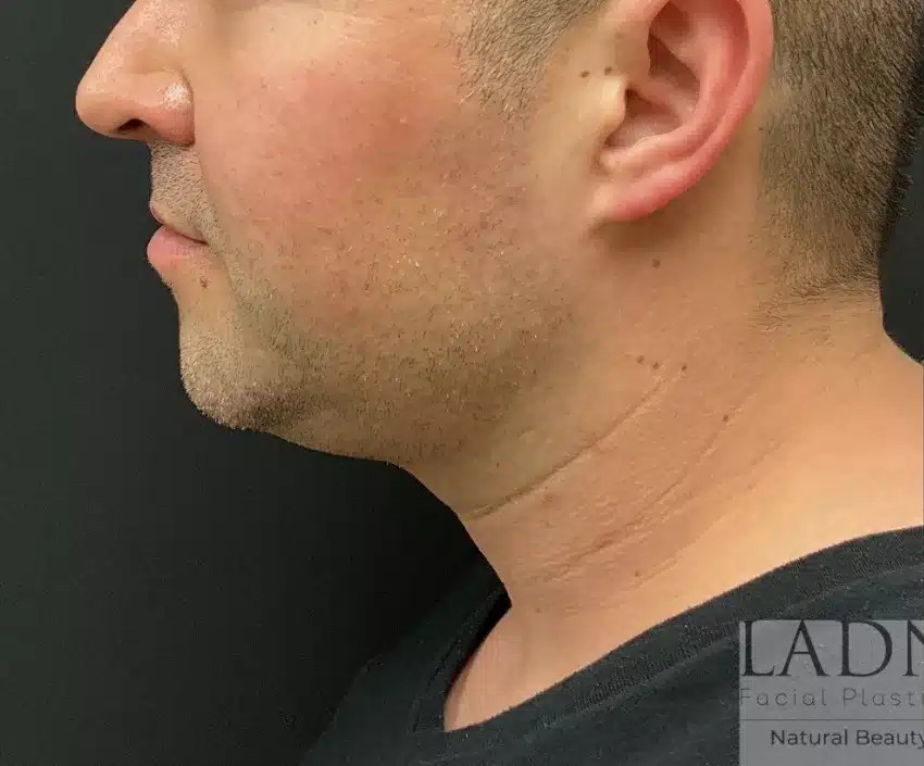 Chin Augmentation before and after - before