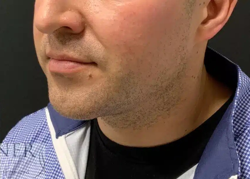 Chin Augmentation before and after - after