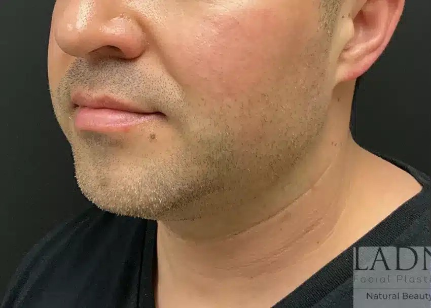 Chin Augmentation before and after - before