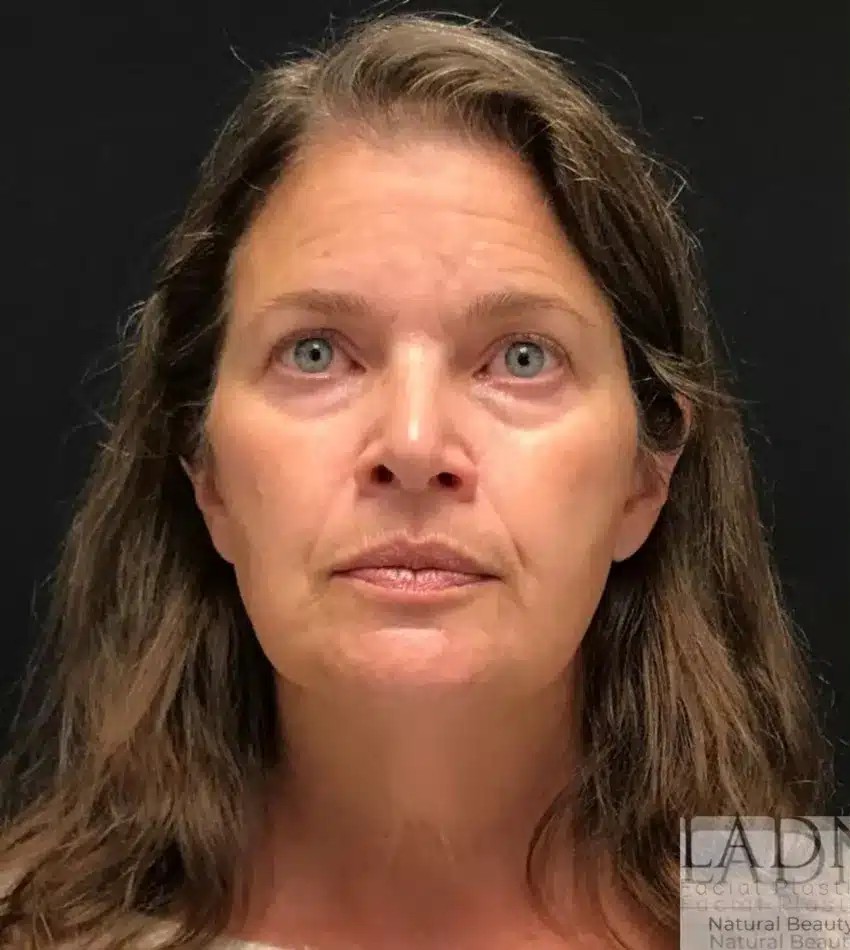Deep Plane Facelift / Neck Lift before and after - before