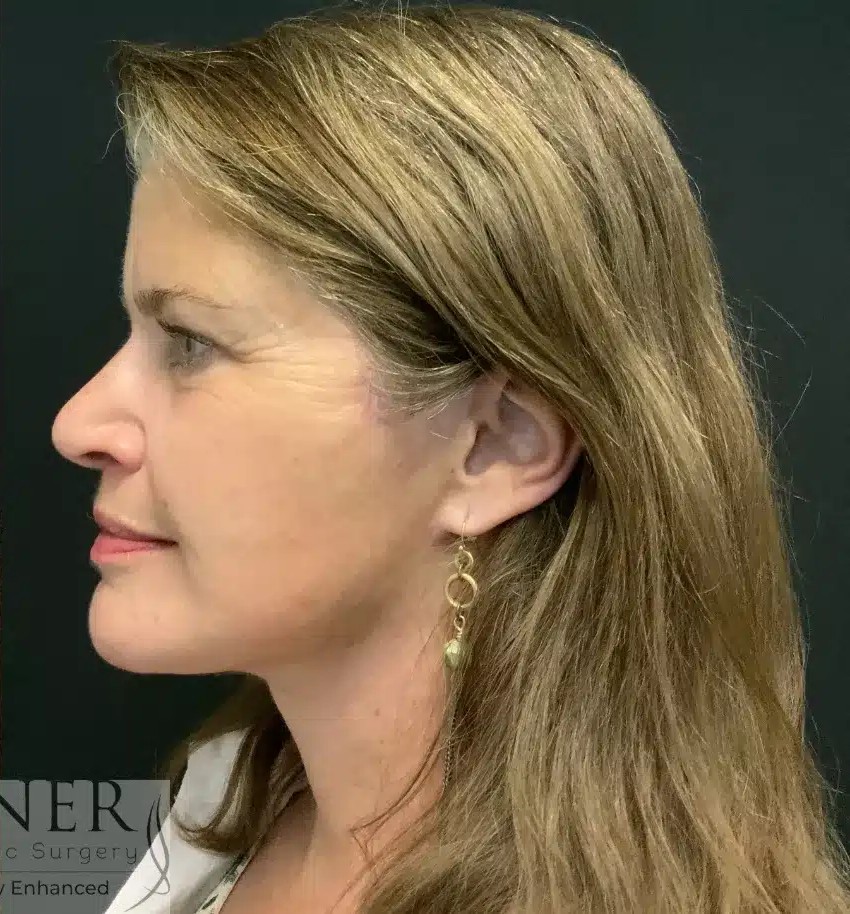 Deep Plane Facelift / Neck Lift before and after - after