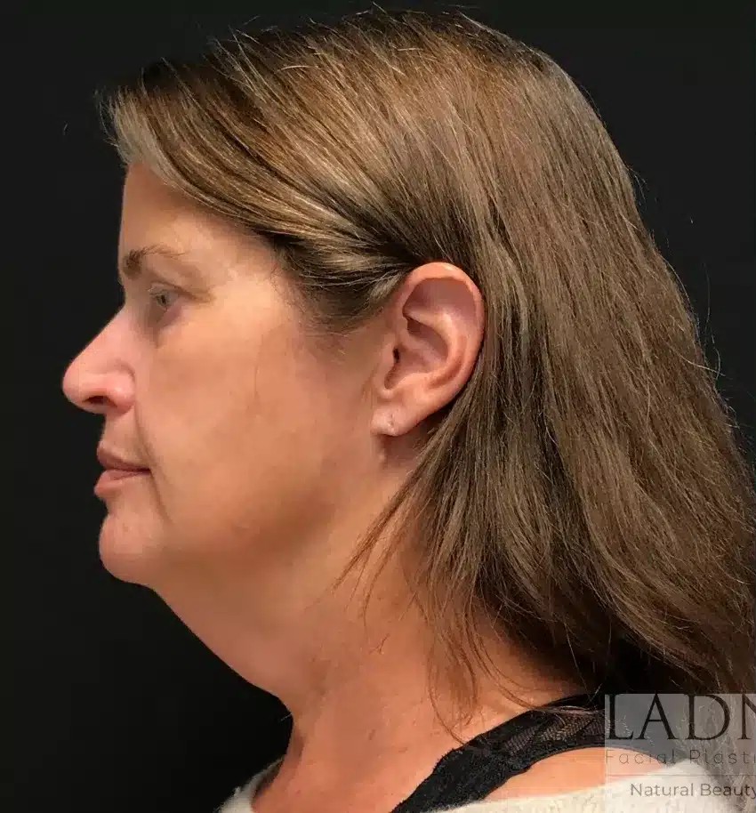 Deep Plane Facelift / Neck Lift before and after - before