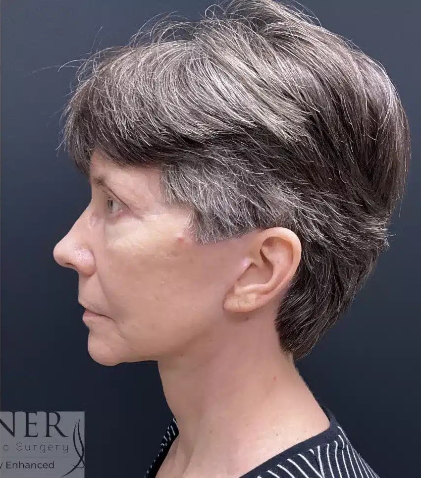 Lower Deep Plane Facelift, Blepharoplasty, Brow Lift/Forehead Lift, & Facial Fat Transfer before and after - after