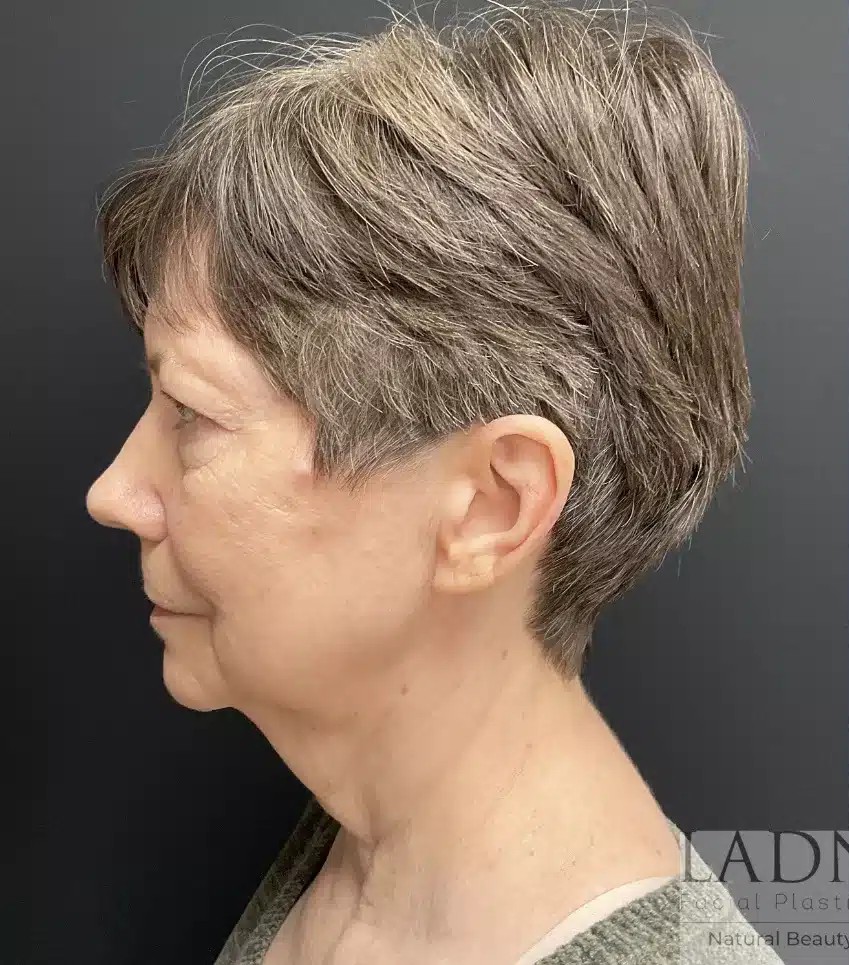 Lower Deep Plane Facelift, Blepharoplasty, Brow Lift/Forehead Lift, & Facial Fat Transfer before and after - before