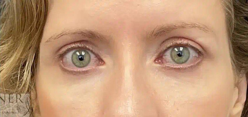 Upper and Lower Blepharoplasty before and after - after