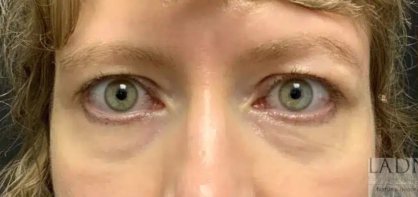 Upper and Lower Blepharoplasty before and after - before
