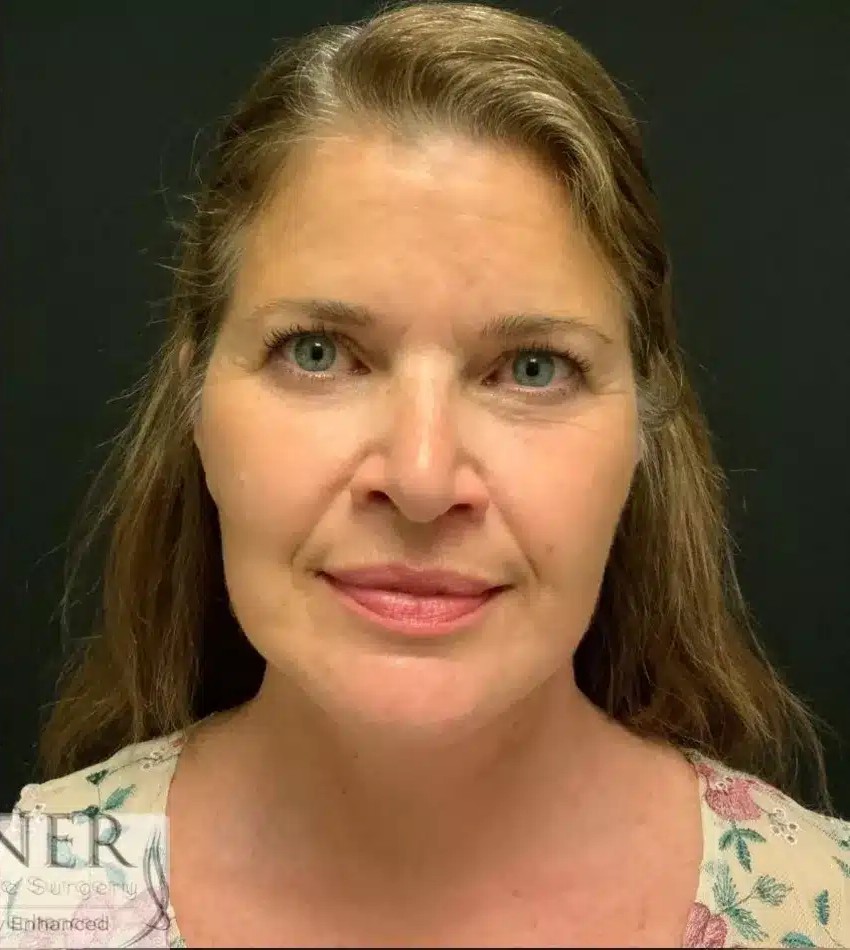 Upper and Lower Blepharoplasty before and after - after
