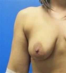Breast Lift before and after - before