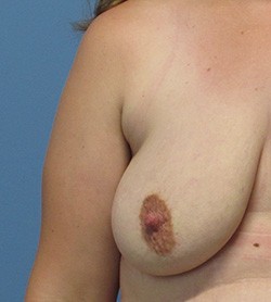 Breast Lift before and after - before