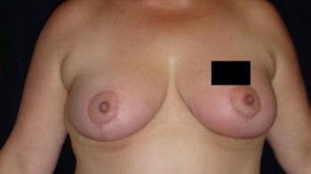 Breast Lift before and after - after