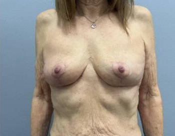 Breast Lift before and after - after