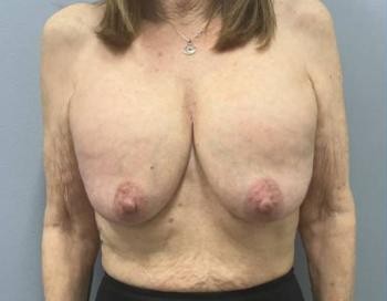 Breast Lift before and after - before
