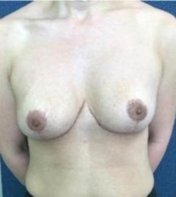 Breast Reduction before and after - after