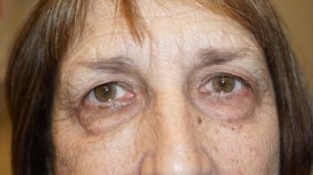Brow Lift before and after - before