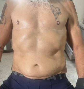 Body Contouring before and after - after