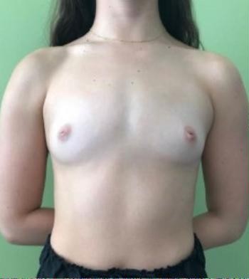 Breast Augmentation before and after - before
