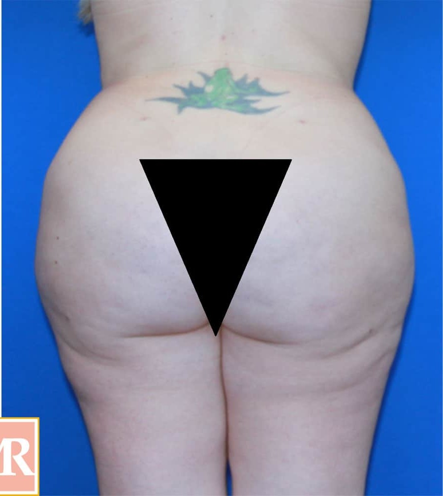 Brazilian Butt Lift before and after - after