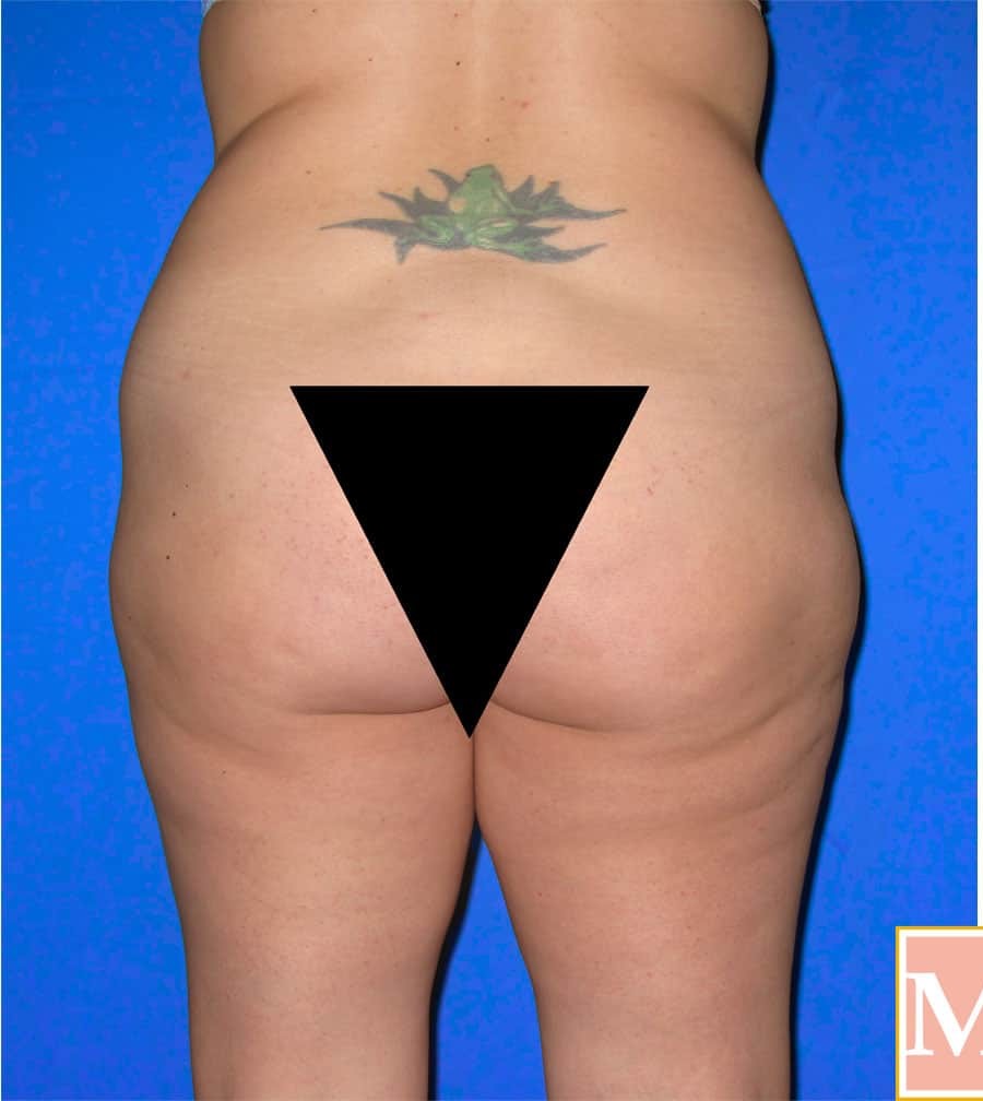 Brazilian Butt Lift before and after - before