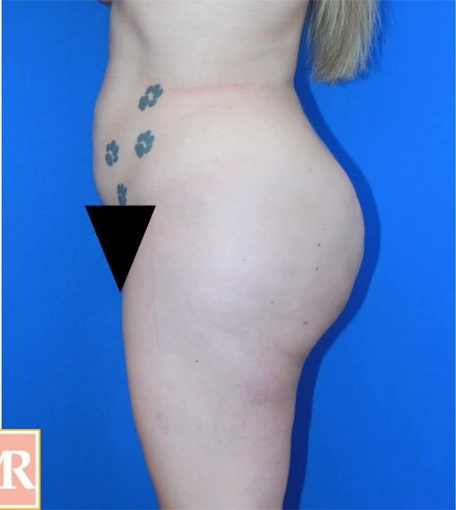 Brazilian Butt Lift before and after - after