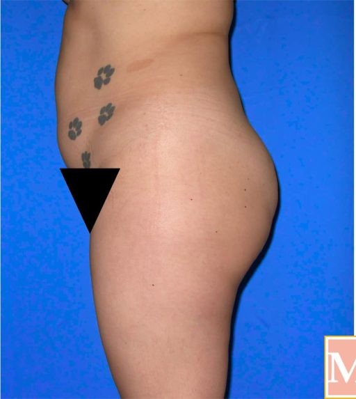 Brazilian Butt Lift before and after - before