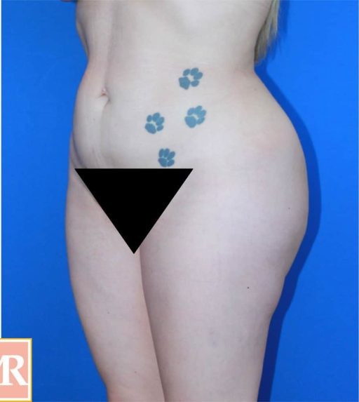 Brazilian Butt Lift before and after - after