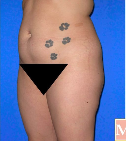 Brazilian Butt Lift before and after - before