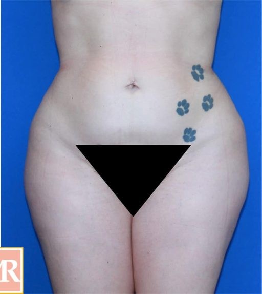 Brazilian Butt Lift before and after - after