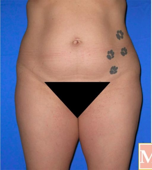 Brazilian Butt Lift before and after - before