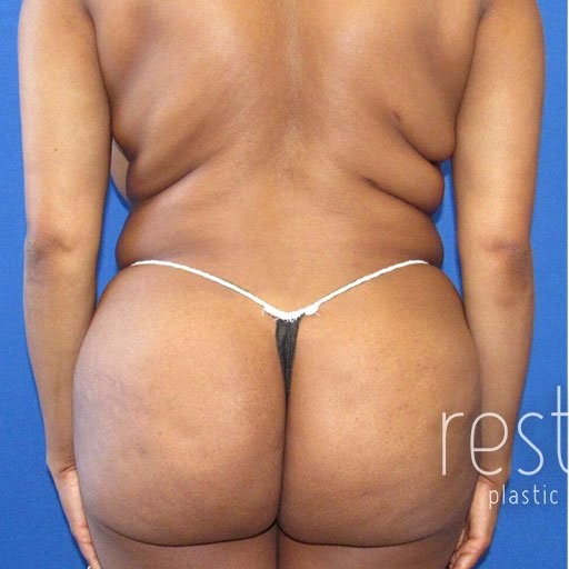 Brazilian Butt Lift before and after - before