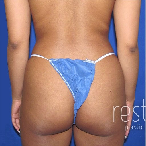 Brazilian Butt Lift before and after - before