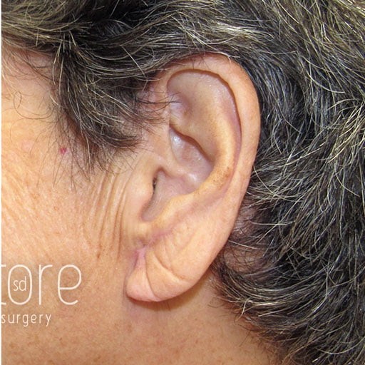 Ear Surgery before and after - after