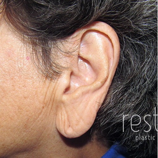 Ear Surgery before and after - before