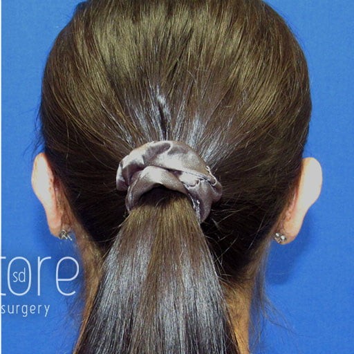 Ear Surgery before and after - after