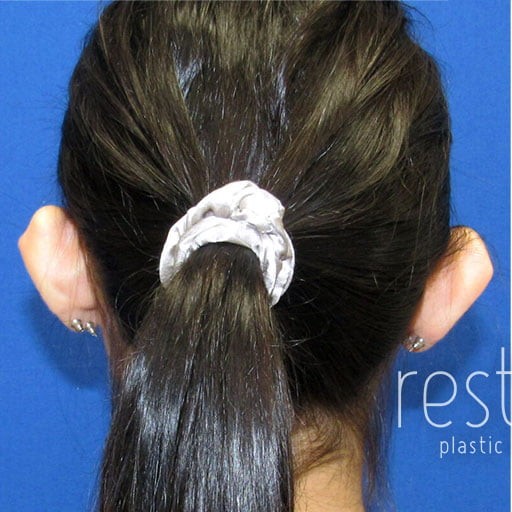 Ear Surgery before and after - before