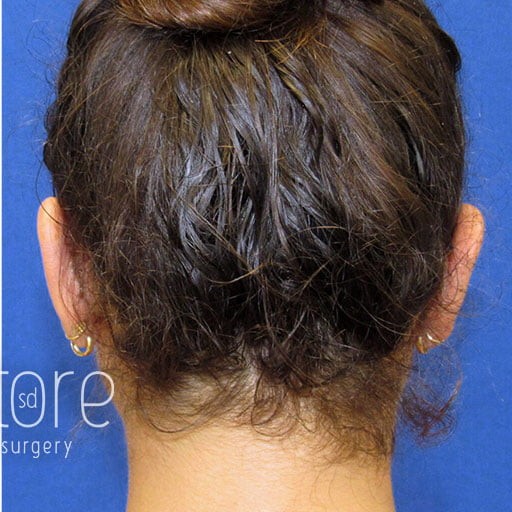 Ear Surgery before and after - after