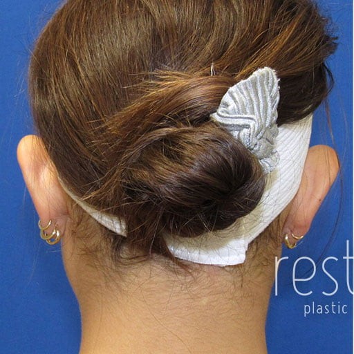 Ear Surgery before and after - before