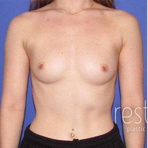 Breast Augmentation before and after - before